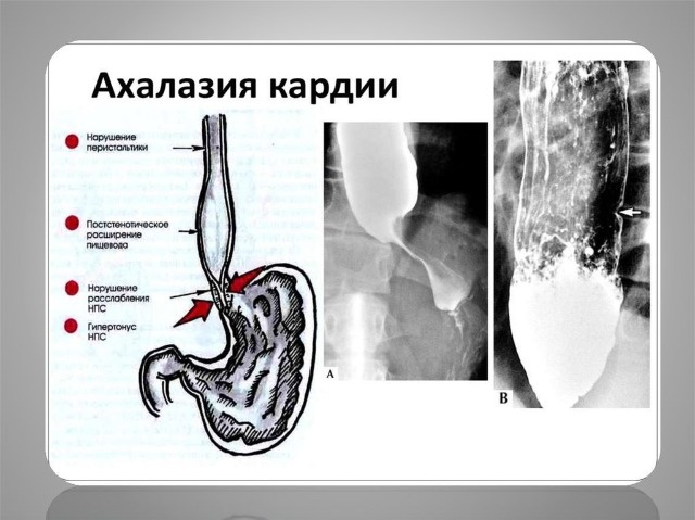 не проходит еда, ахалазия кардии